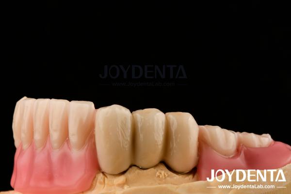 Stainless Steel Prostheses Partial Dentures Attachments Polished Surface Ball