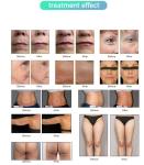 YW0001 Professional Desktop 7d Hifu Body And Face Lifting Machine Fractional Rf